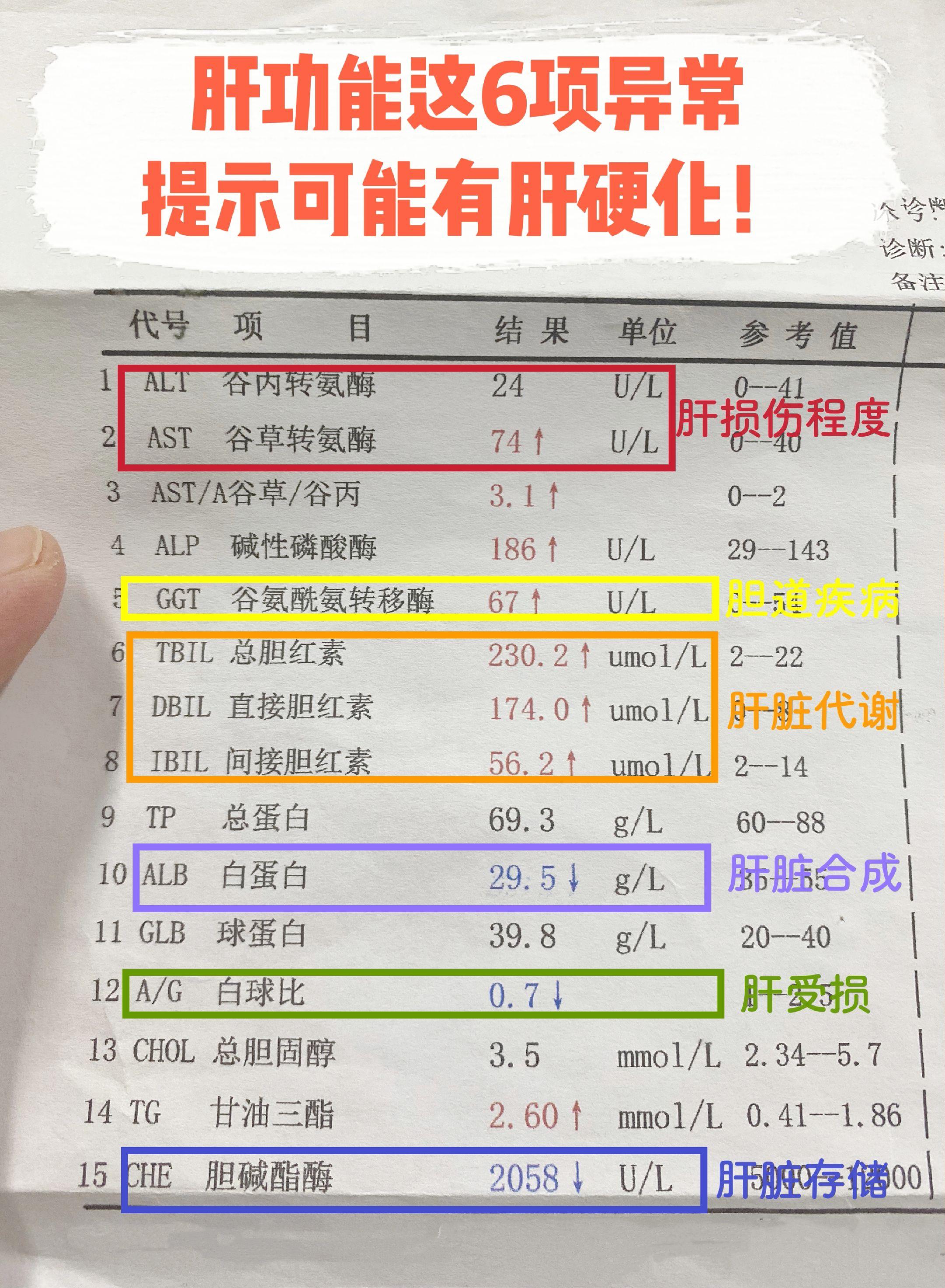 肝功能这6项异常，注意！1、转氨酶：转氨酶包括谷丙和谷草，这两项都存在...