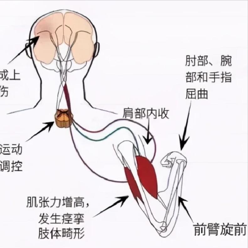 偏瘫后别瞎练！弄懂这3个原理是关键！原理一：偏瘫是大脑与肌肉“断线了”问题
