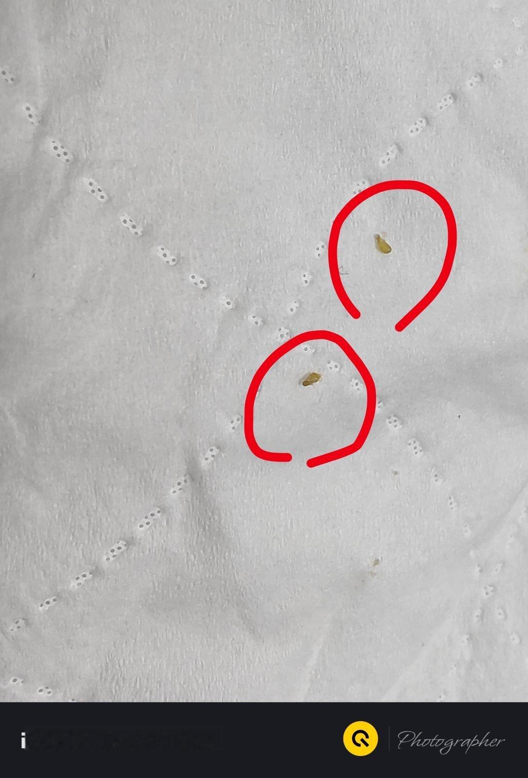 脸上闭口真的很多，在iQOO的2倍镜头下面拍的很清晰，全是成熟以后的脂肪粒