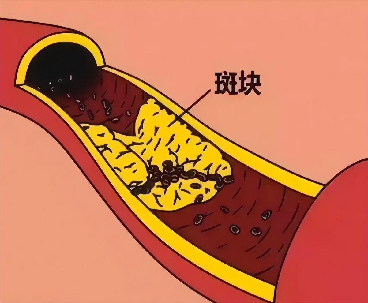 能说180遍，世界上没有哪一个药吃进去就能化掉斑块，通血管才是关键！我是医生，