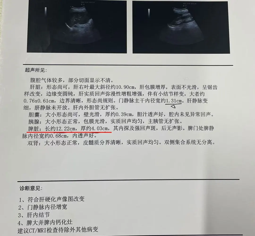 肝硬化脾大不一定都缩脾，尤其是在早期，保守治疗的效果也非常好，像这位患...