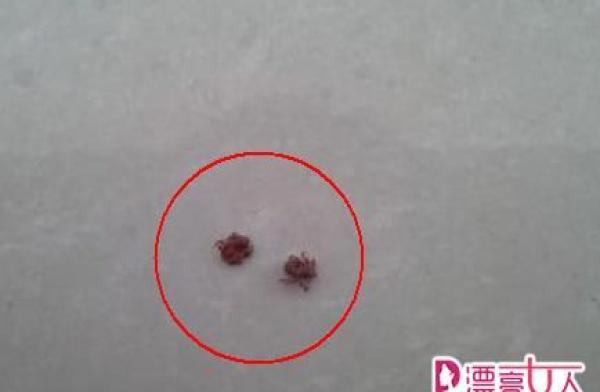 女子身上这部位长不明黑包 揪出来惊呆医生