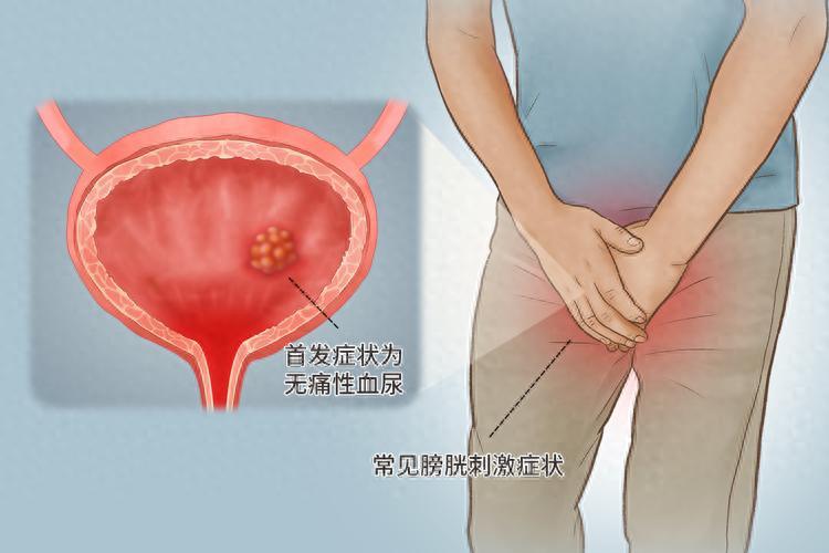 68岁男子因膀胱癌离世！提醒：小便出现这3种异常，不可疏忽大意膀胱癌几乎不会