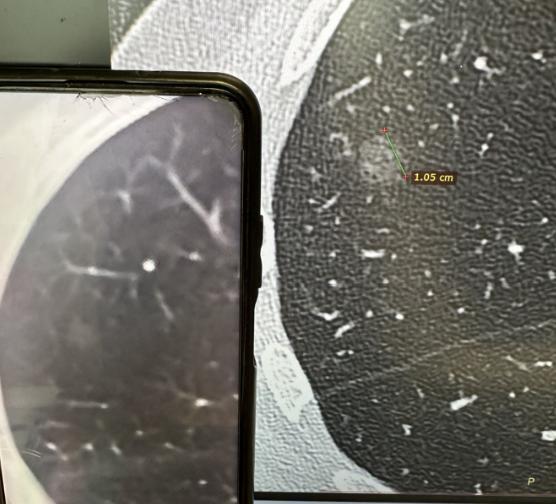 8mm肺磨玻璃结节，大小不变、密度升高，还能继续观察吗？门诊接诊了一位随访一年多