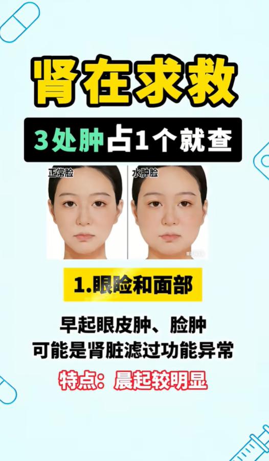 莫名浮肿别当成喝水太多！三处肿胀，小心肾脏负担过重
