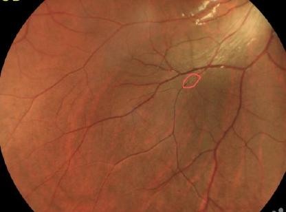 4月18日晚，福建福州，一年轻小伙突然间发现，自己右眼看不见了。他一路狂奔，不到