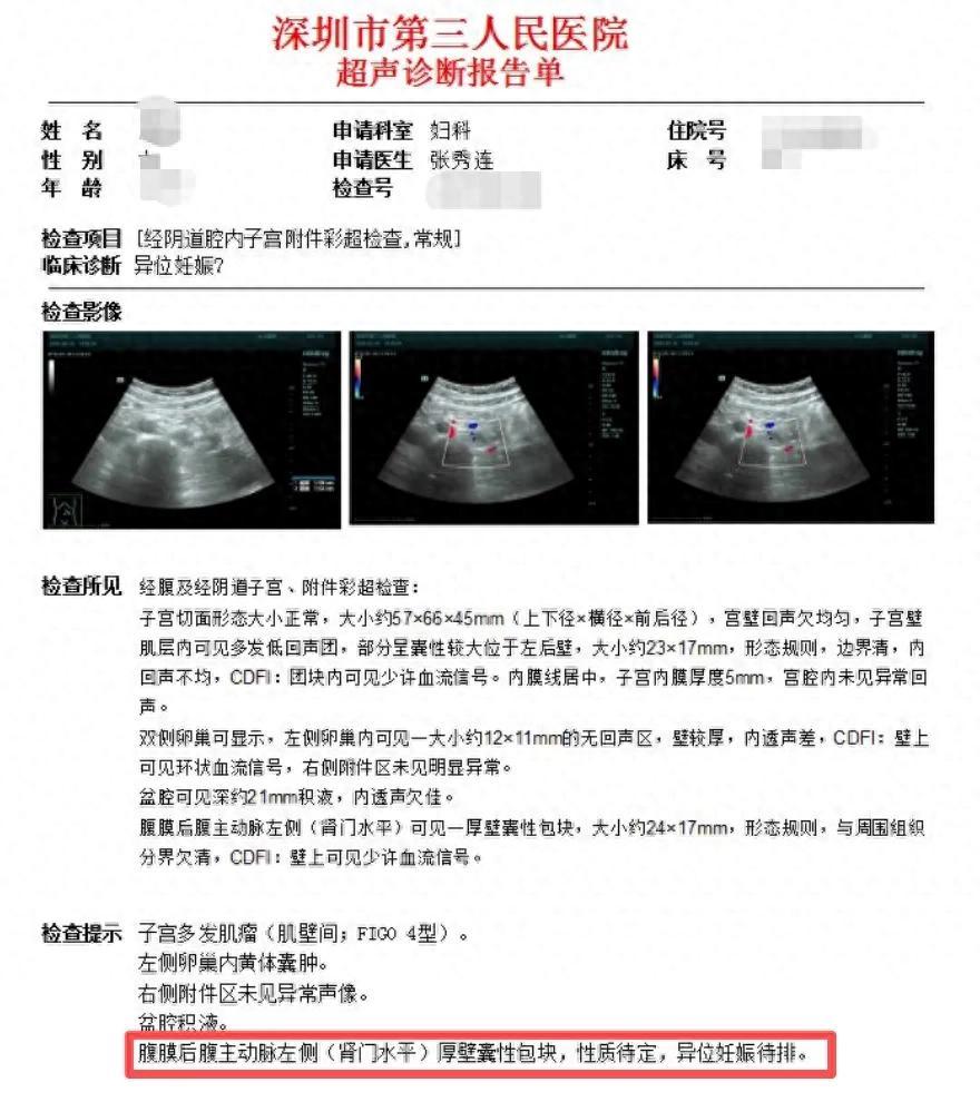 女子确认怀孕，B超却找不到孕囊，检查结果让人意外。很多人以为早孕B超就是去
