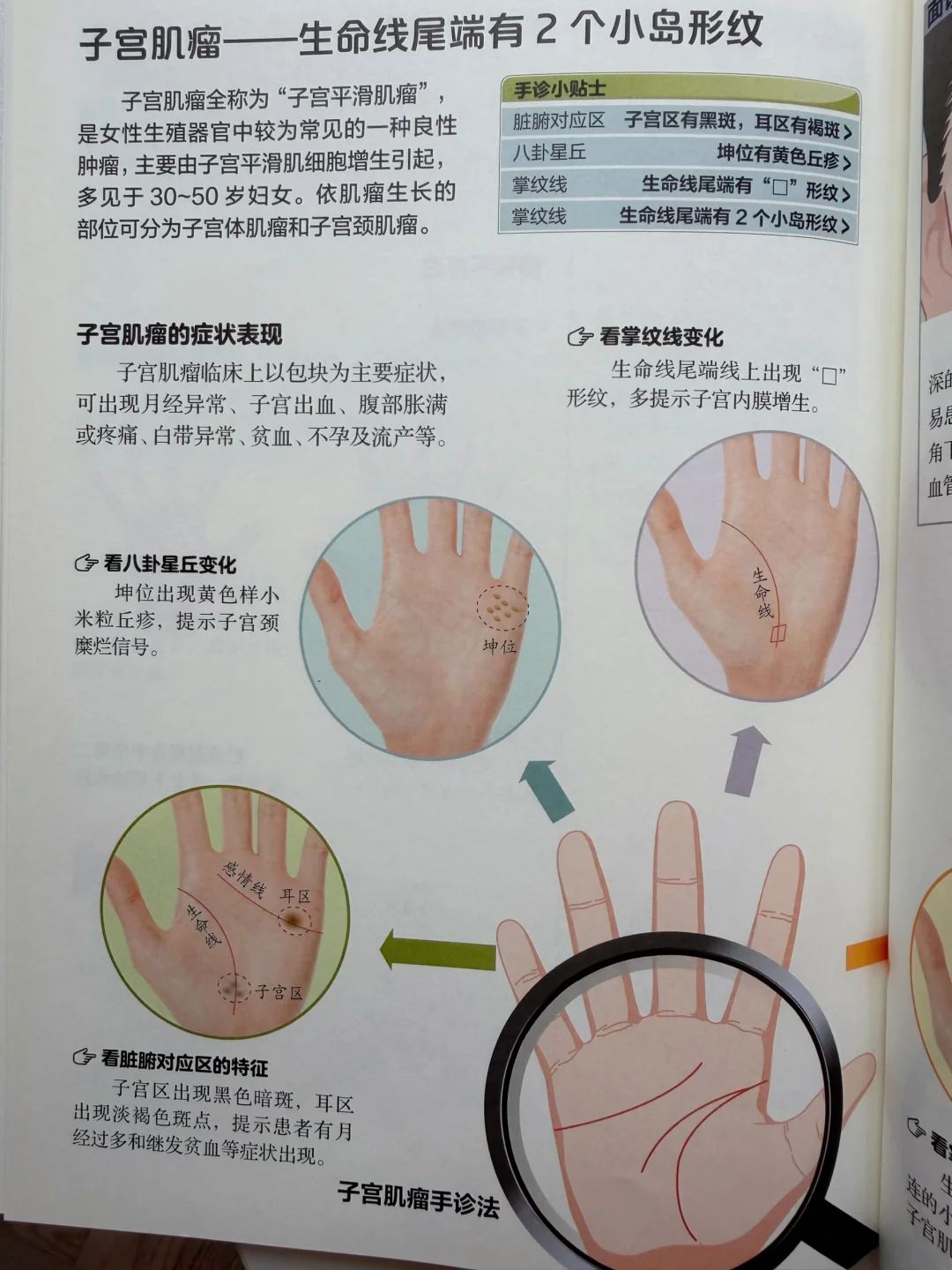 子宫肌瘤