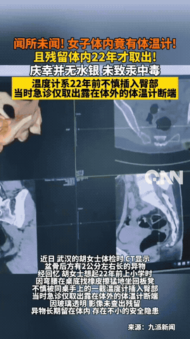 “彻底解释不清了！”湖北武汉，一女子参加体检时，意外发现盆骨里有奇怪异物，2公分