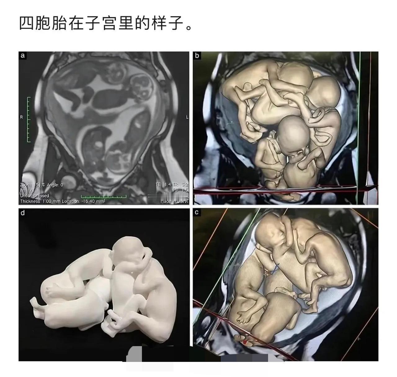 四胞胎在子宫里的温馨时刻，珍贵瞬间定格！👶🏻👶🏻👶🏻👶🏻