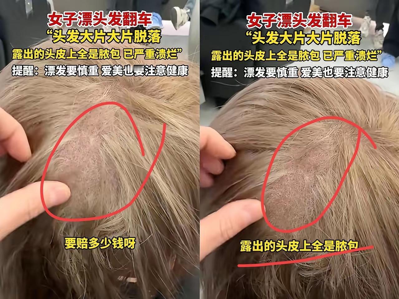 真没想到呀上海一女子去理发店染发理发师一掀她头发，里头头发大把​脱落，头皮