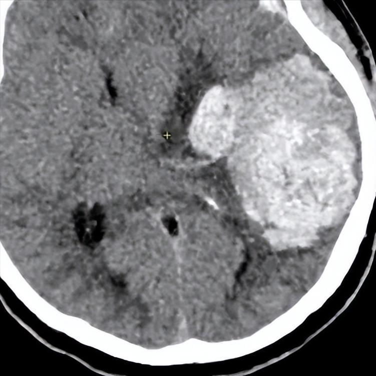 脑出血后如何安稳渡过“三道坎”？护理要点告诉你第一阶段：出血控制期这是最危