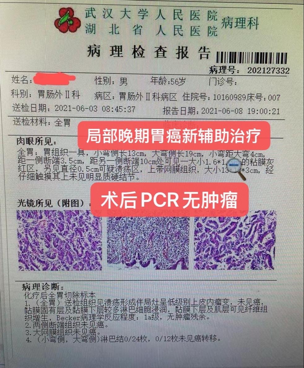 四个局部晚期肿瘤:新辅助治疗后全部PCR.局部晚期右半结肠癌、宫颈癌...