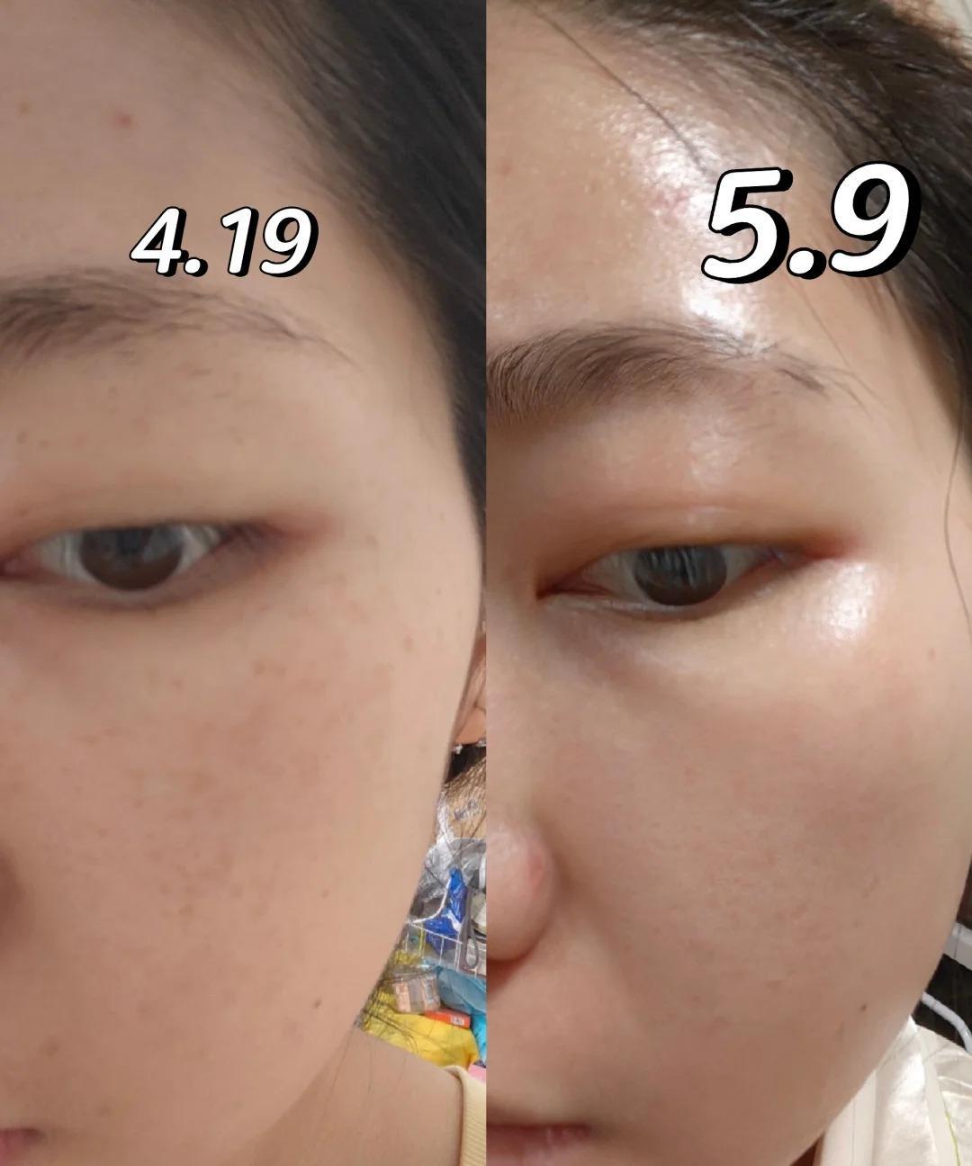 三招天然去斑法，我上网学的方法，自己试了有效，素颜也能打！姐妹们，你们是不是也