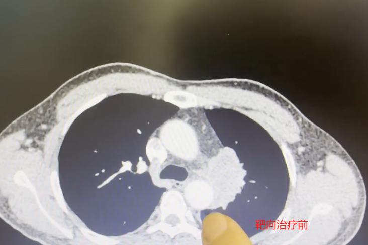 这位患者52岁，抽烟多年，前段时间突然嗓子哑了，一开始还以为是普通感冒引起的，自