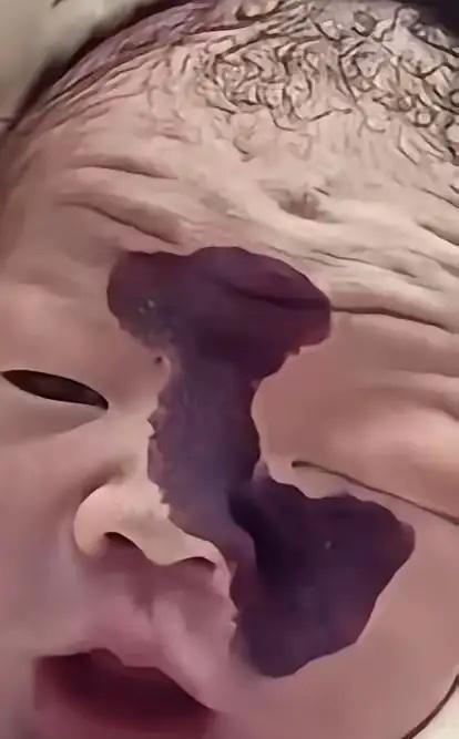 看哭了！一对年轻夫妻，怀孕时在检查室看到宝宝脸上有一道黑影，医生说可能是胎记，丈