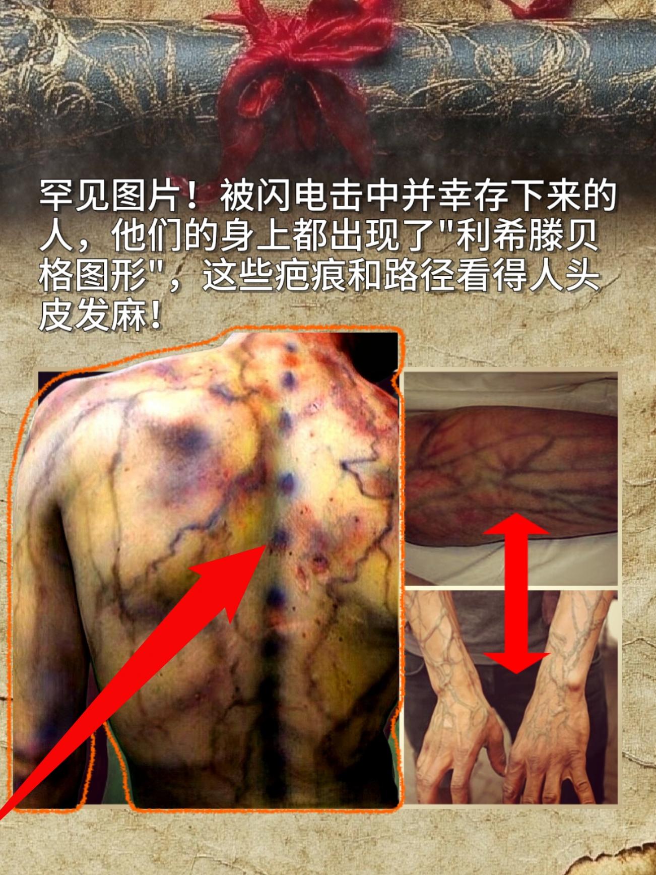 罕见图片！被闪电击中并幸存下来的人，他们的身上都出现了"利希滕贝格图形...