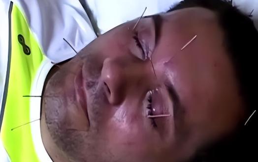 整整9000针，这简直是奇迹！2008年，美国著名运动员戴维全身瘫痪，求助中国一