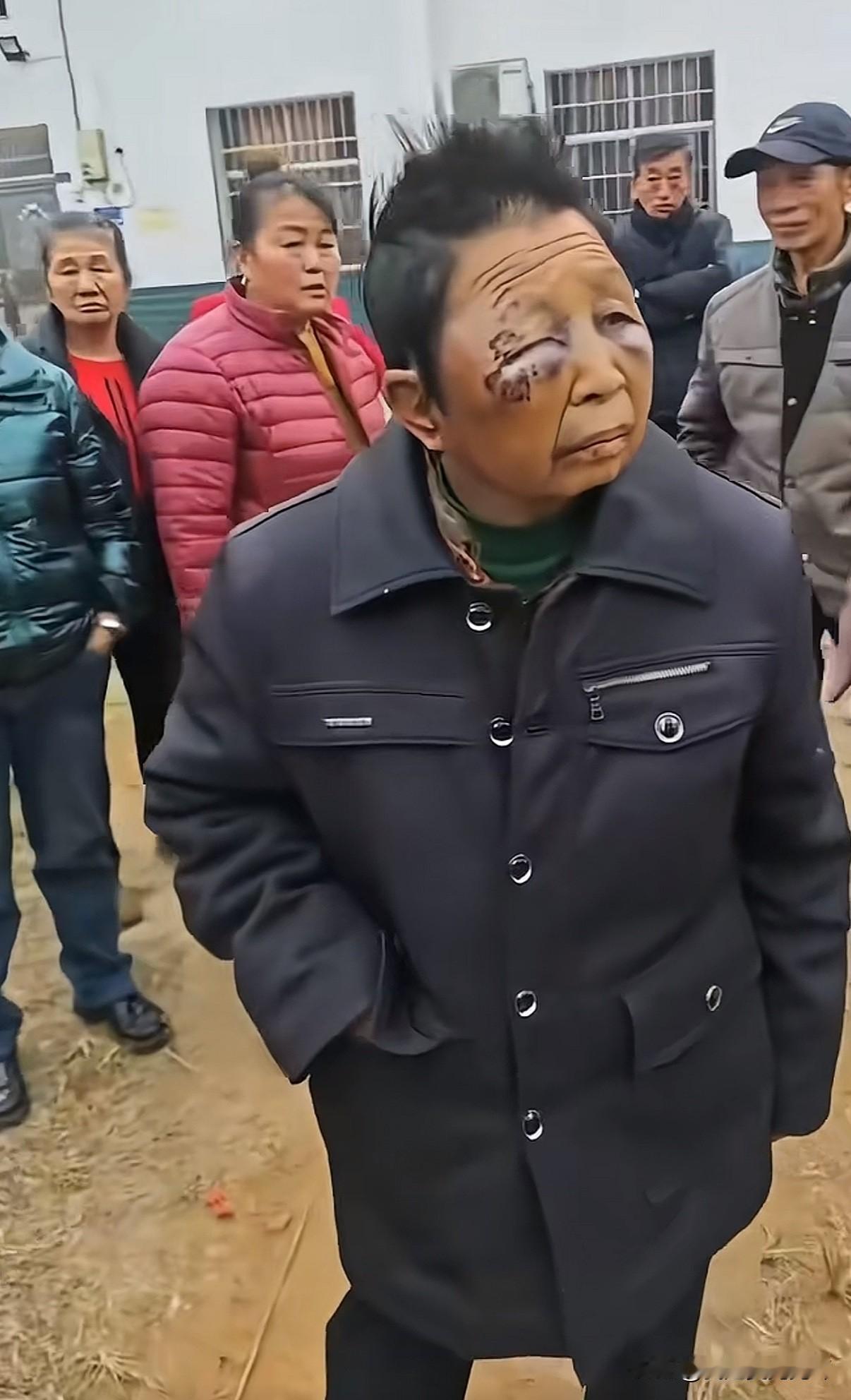 她才45岁却被家暴折磨成像她那该死的75岁丈夫一样苍老她整张脸高高肿起布满新