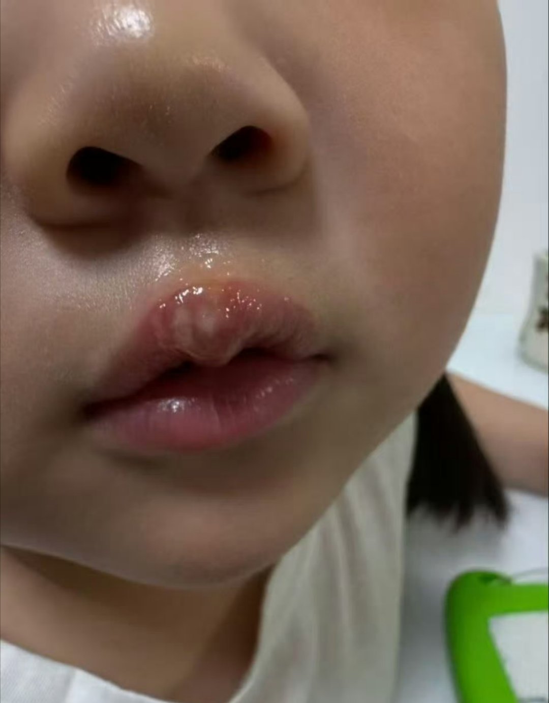 女童被幼儿园老师用热熔胶烫嘴虐待愤怒过后我在想，为何呢？？？这种人为什么要这么干