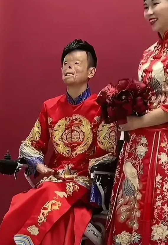 一名90后小伙为救女孩严重烧伤，从一个帅气的小伙，如今变得面目全非，只为了救一个