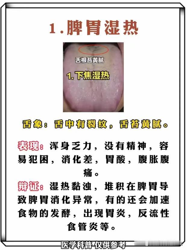3种湿热体质舌象，一眼分清脾胃、肠道与肝胆问题