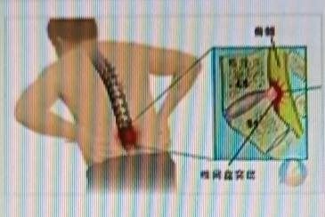 腰椎间盘突出太折磨人？我有缓解腰痛的妙招。我亲测有效的「仰卧腰椎牵引式」，在家
