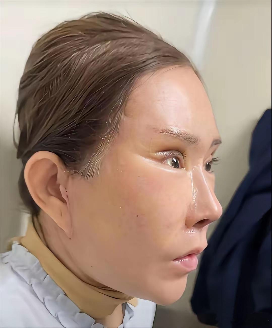 杨女士提眉、除皱、割双眼皮后维权。老板同意协商赔偿200块钱了事。