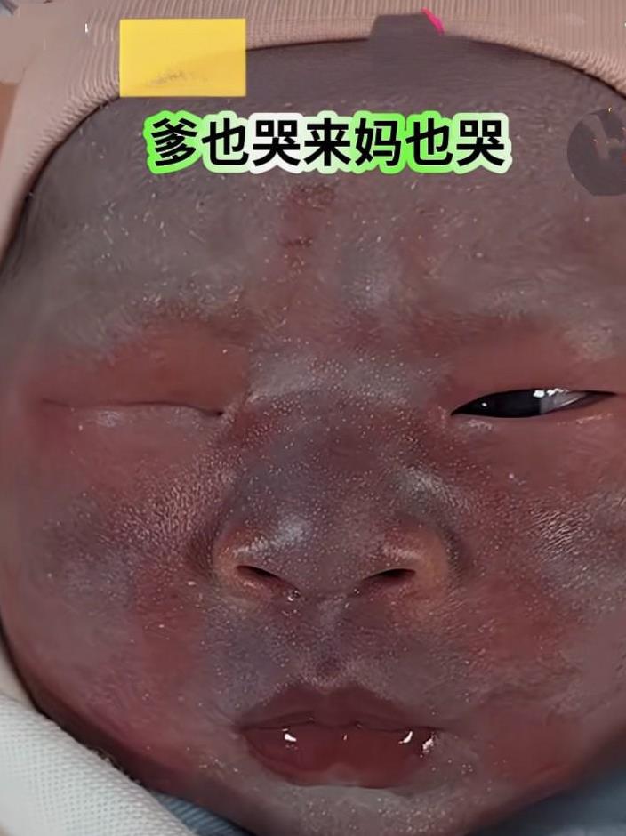 一对年轻宝妈晒出他们刚出生的宝宝照片，只见宝宝脸部皮肤的颜色不一样，脸部中间部分