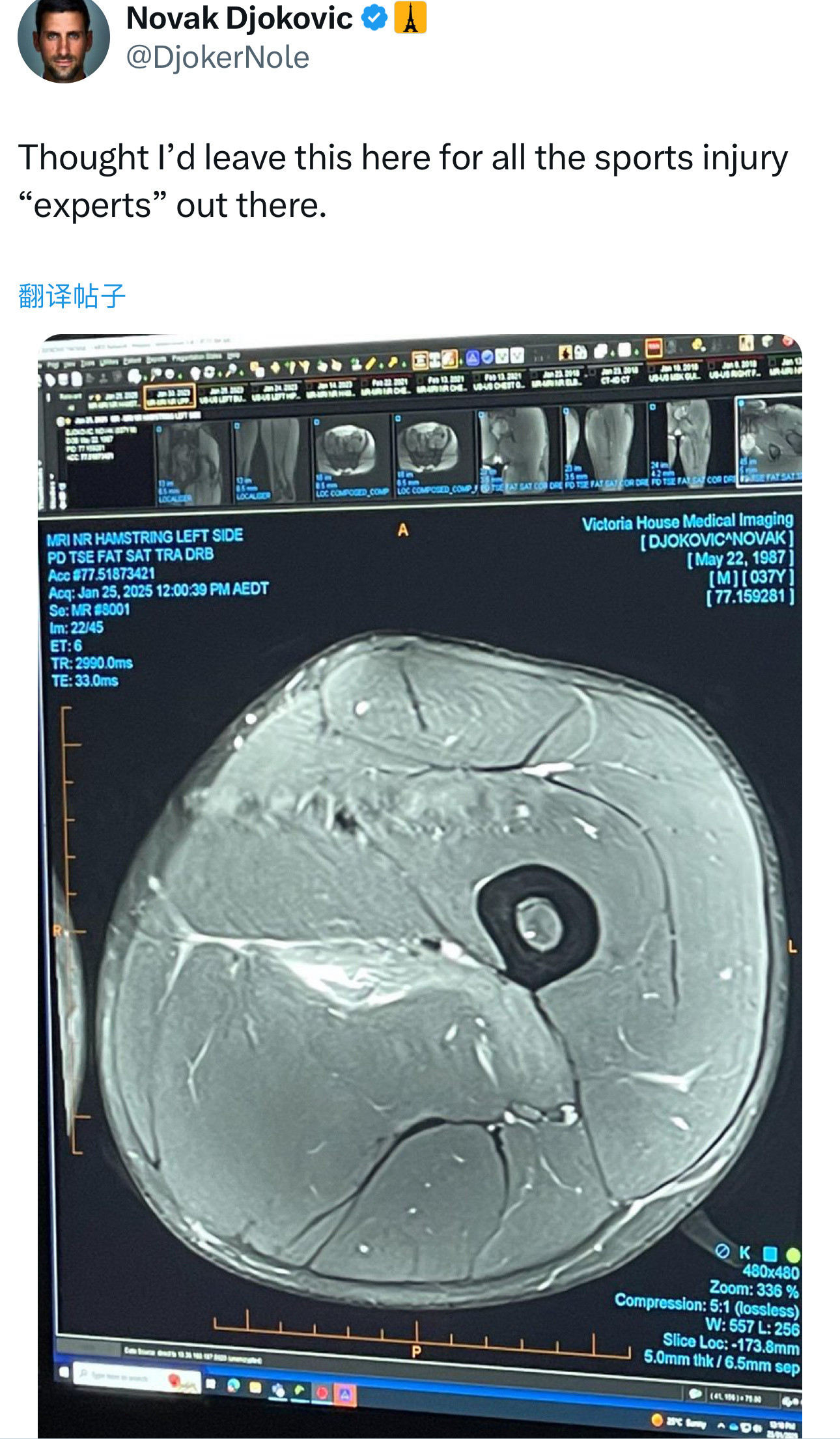 德约科维奇发出复诊后拍的片子，表示是留给所有网络运动伤害的“专家”看的。有真正的