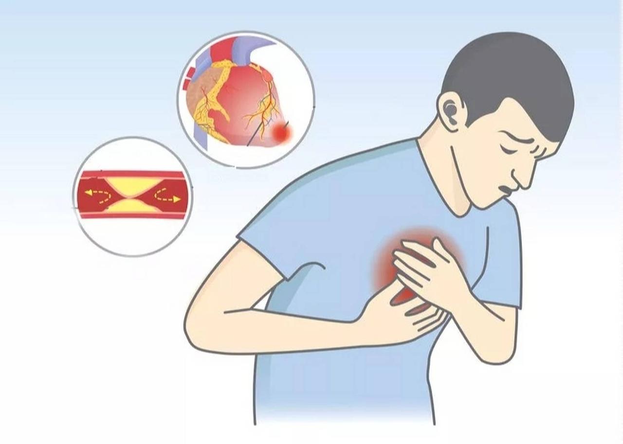 关于心绞痛发作时三种常用急救药物硝酸甘油（首选）·用法：舌下含服1片（