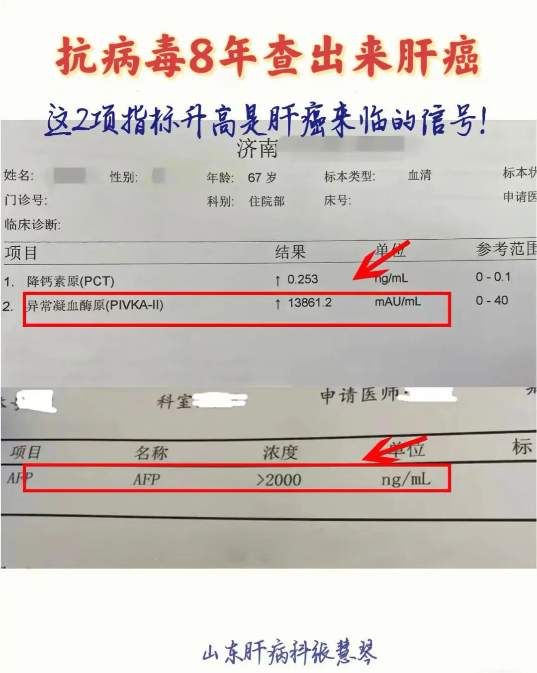 乙肝抗病毒8年查出肝癌，这2个指标升高警惕