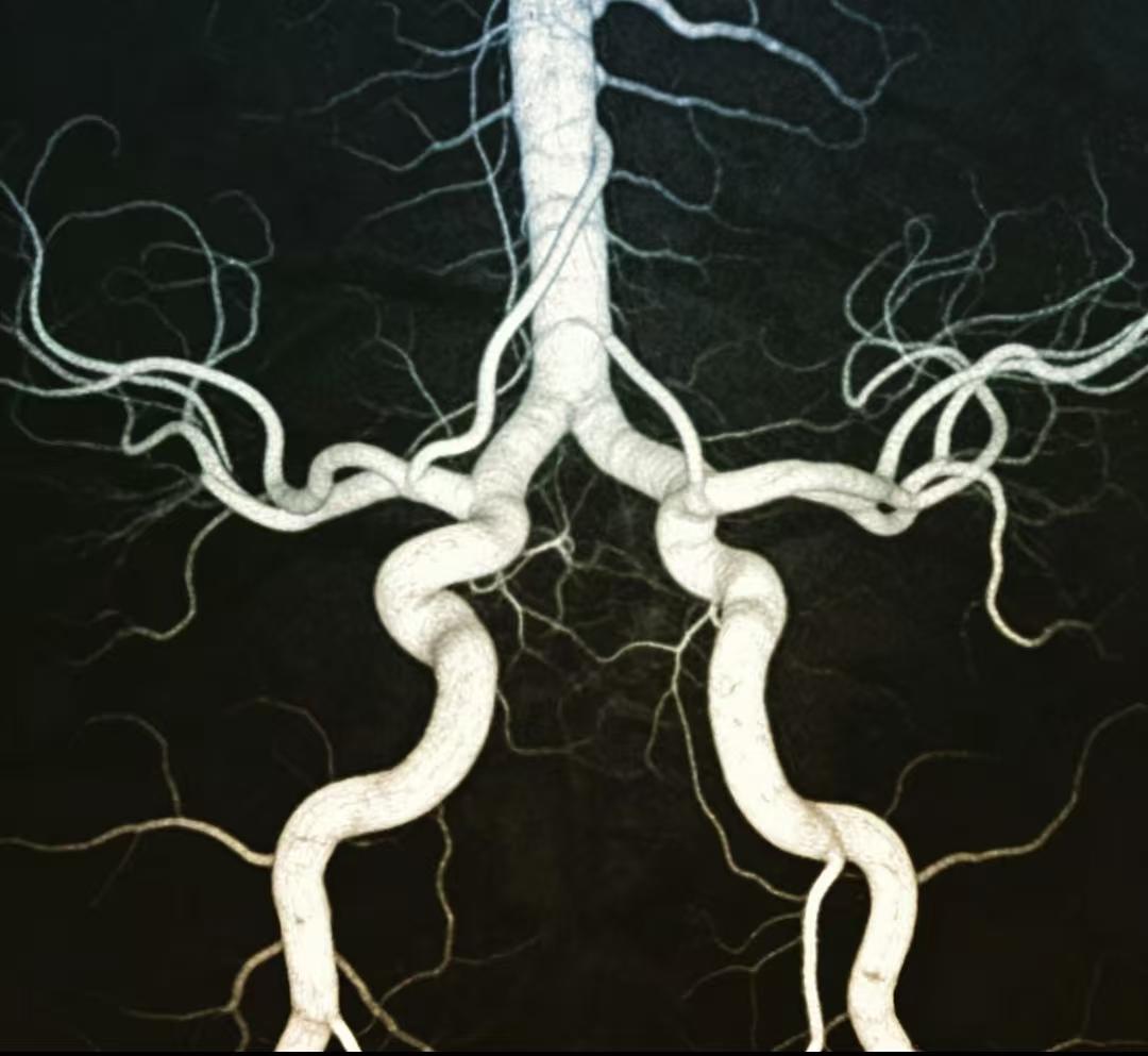 我一个同事经常头痛、头晕，我昨天陪她去看了医生。在医生的强烈劝说下，她终于下定决
