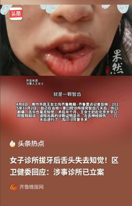 河南焦作，女子要备孕，就想提前把智齿拔掉，结果牙齿一拔，她整个舌头都没有知觉了。