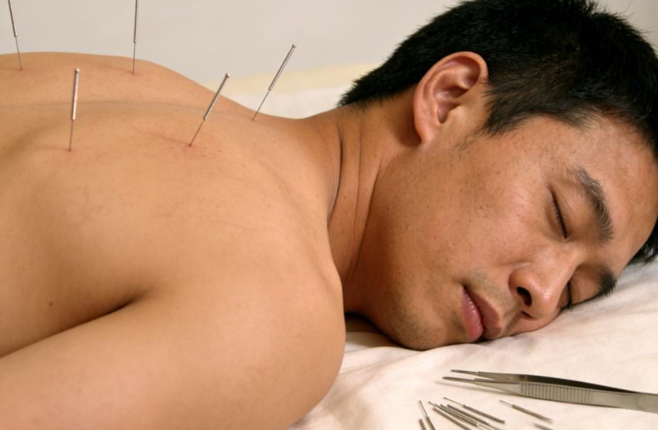 过度针灸会伤身！针灸的这些常见误区，你知道吗针灸是咱们熟悉的传统养生方式