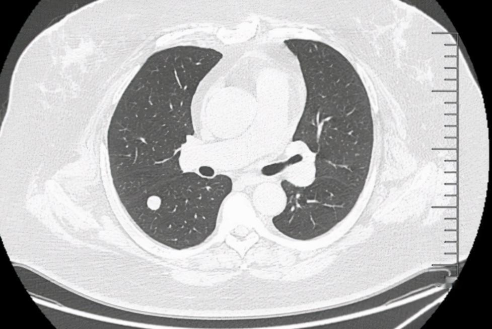 体检发现结节？这5种天然“散结小食材”，建议常吃体检查出结节，确实会让人心里一