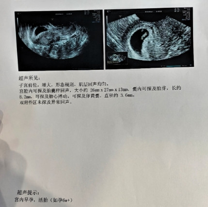 惊不惊喜，意不意外，刺不刺激前几天发现怀孕了，还以为是假的，今天做了一个B超，