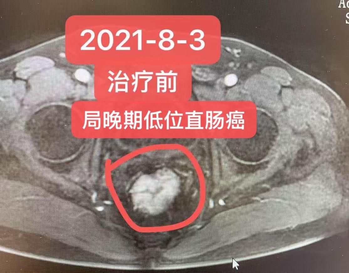 局晚期低位直肠癌拒绝手术的新选择。患者男，54岁，2021年7月26日...