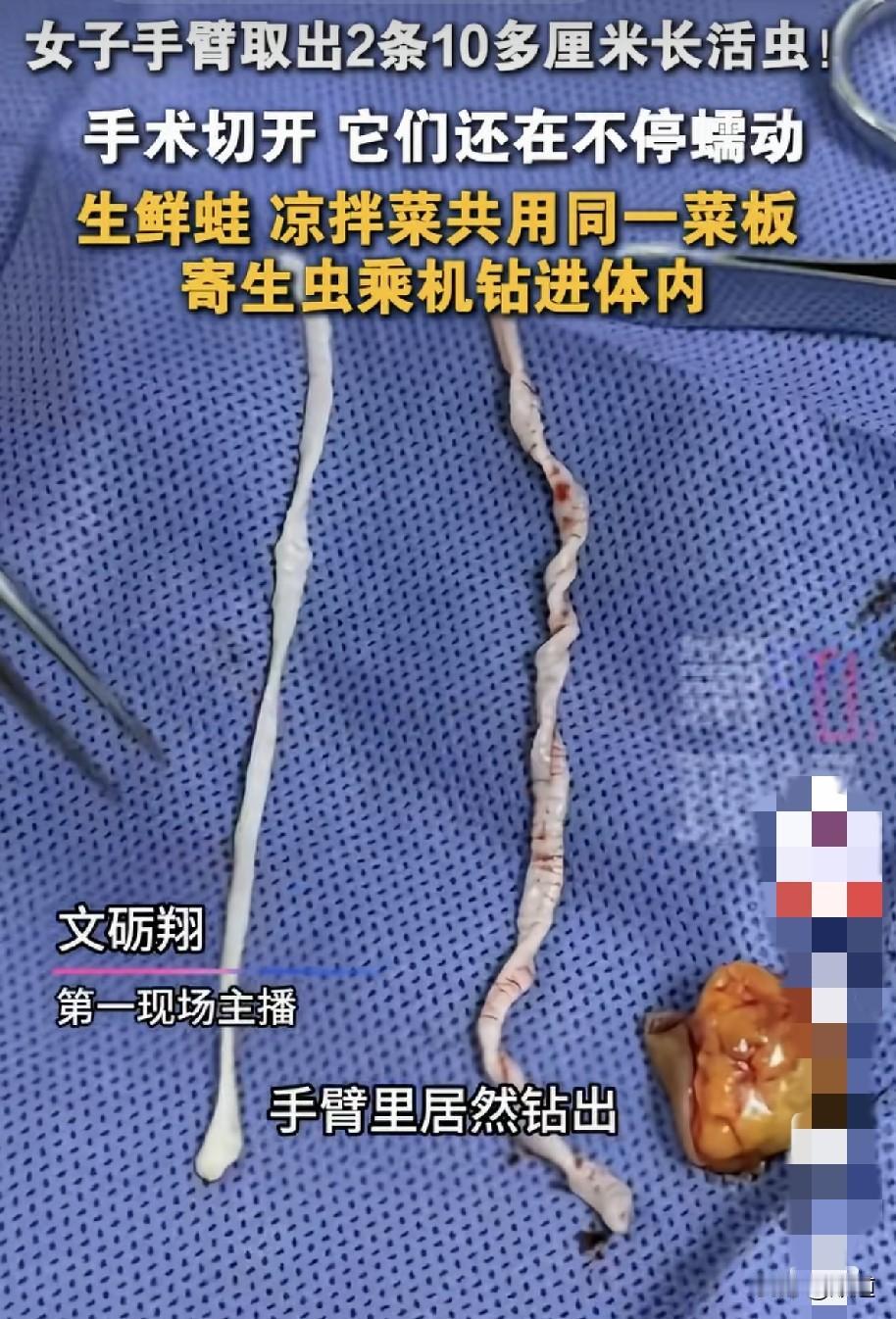 深圳的王女士一年前左前臂长了一个包，她也没当回事儿，没想到这个包越长越大，还越来