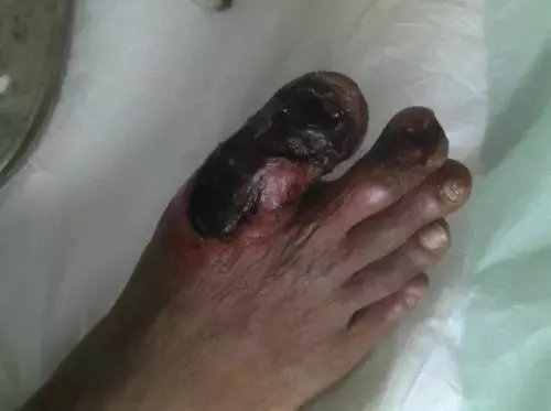 脉管炎有多可怕? 烂手烂脚严重要截肢!