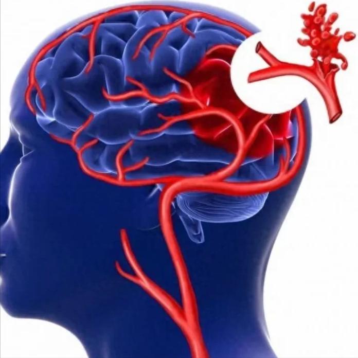 脑出血突发，记住“2要2不要”！关键时候能救命一要：让患者侧着躺不管是在家
