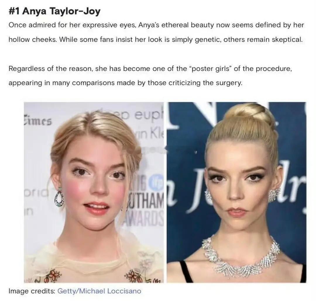 好莱坞整容流行趋势：取颊脂垫