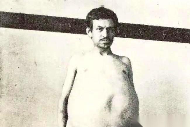 三年没拉屎，肚子里清出来36斤粪便，最后被活活憋死了。这不是段子。这是个真事。