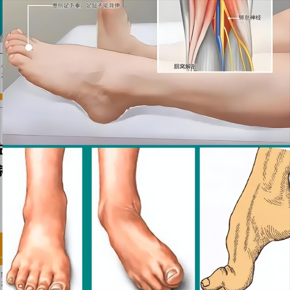 偏瘫练走路，脚上的问题别大意！一个足托能解决这么多事，很多人不知道足托到底