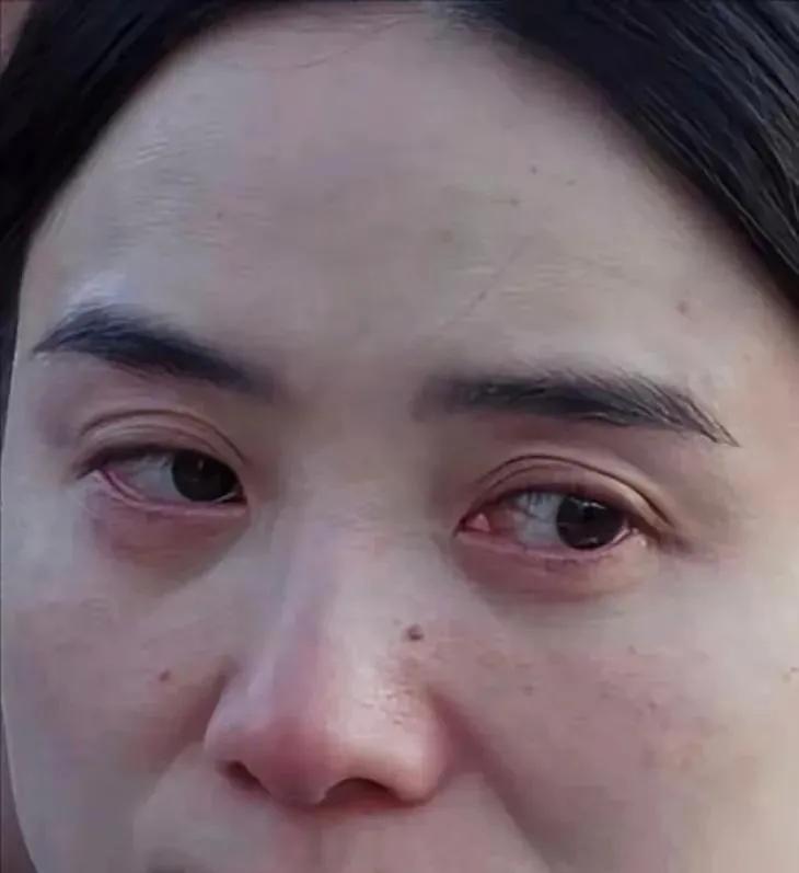 这可是宋佳真实的脸蛋子——雀斑、塌鼻子，鼻翼两边还有淡淡的八字纹，说实话，男人们