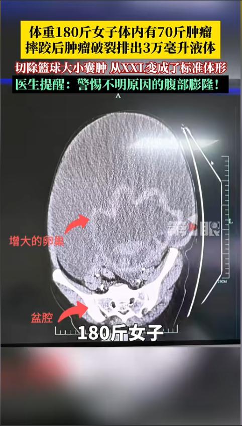 摔一跤瘦了70斤？浙江女子减肥多年无果，医院检查结果让医生当场傻眼。周姐今年40