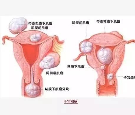 专治子宫肌瘤的一个穴位! 不知道就太可惜了