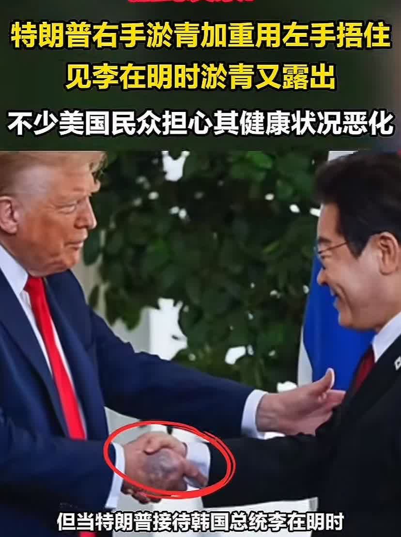 川普这只手着实有点吓人，看脸色挺正常，手上怎么会出现黑紫一大片，感觉不是握手影响