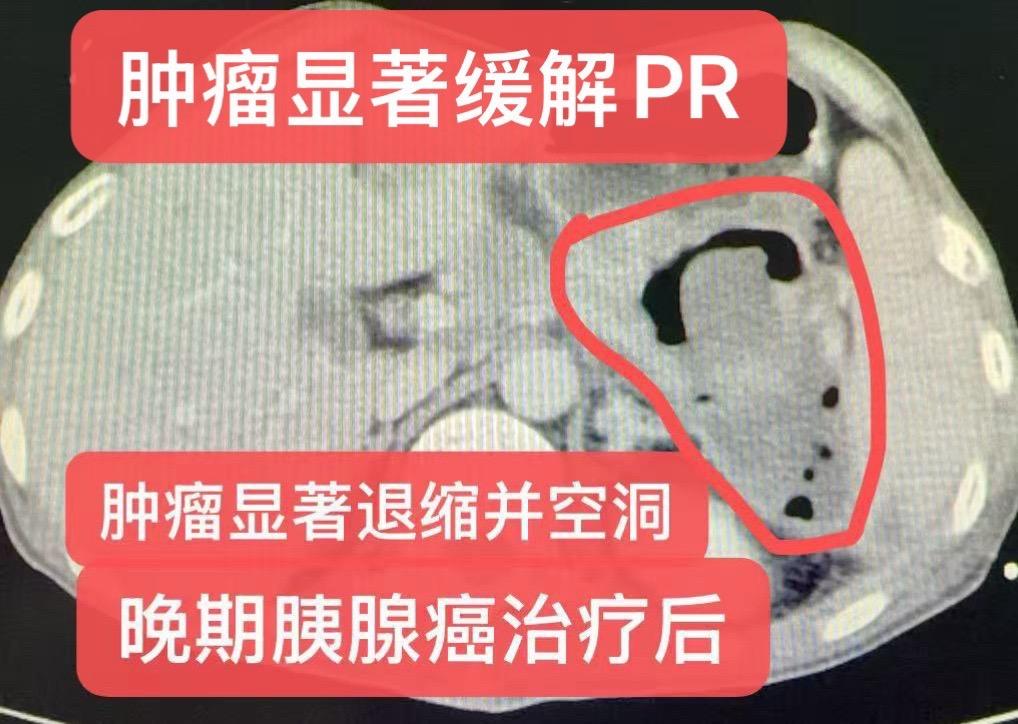 晚期胰腺癌治疗后好转。患者：38岁，男性，既往体健。2026年5月确诊...
