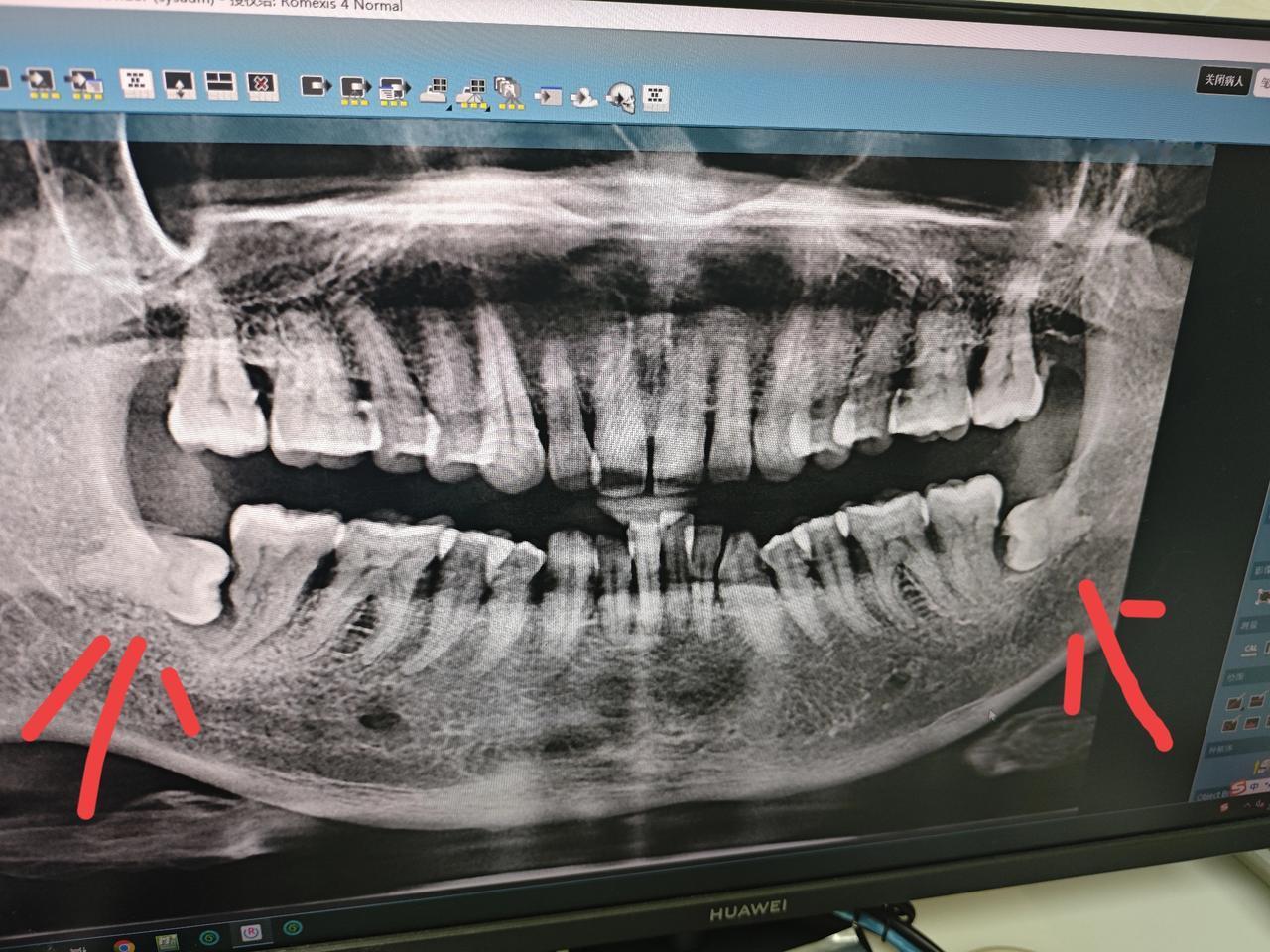 都说每个人有28颗牙齿，但是我却有30颗，还有的人有32颗。最近因为牙齿痛，去